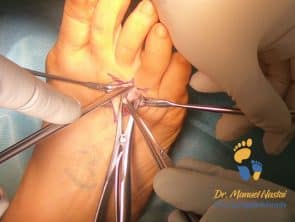 Resektion Morton Neurom