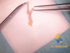 Resezierter morton Neurom
