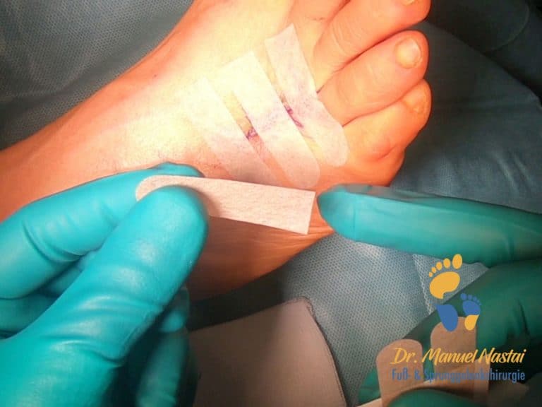 Morton NeuromOperation Dr.medic Manuel Nastai