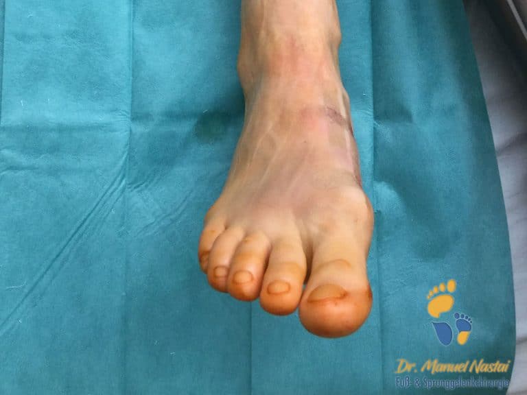 Postoperativer Befund nach minimalinvasiver Hallux valgus OP