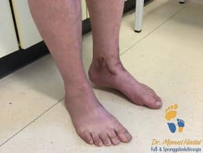 OSG-Arthrodese mit Spitzfußstellung