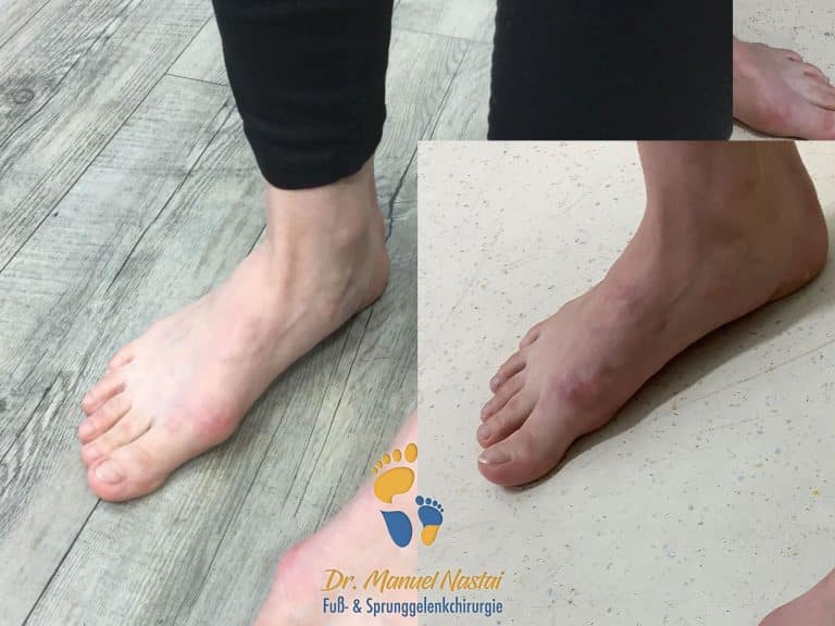 Ergebnis nach minimalinvasiver Hallux valgus Operation