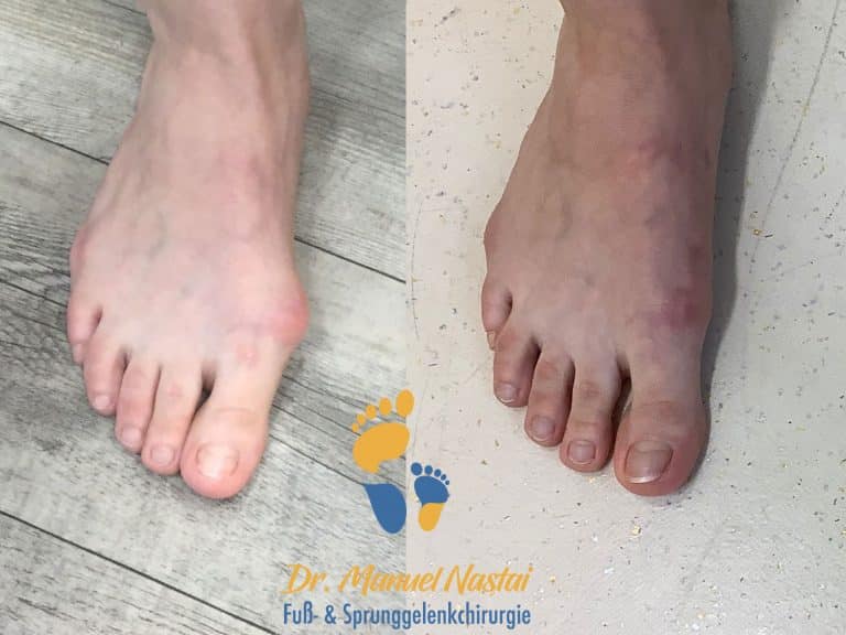Ergebnis nach minimalinvasiver Hallux valgus Operation