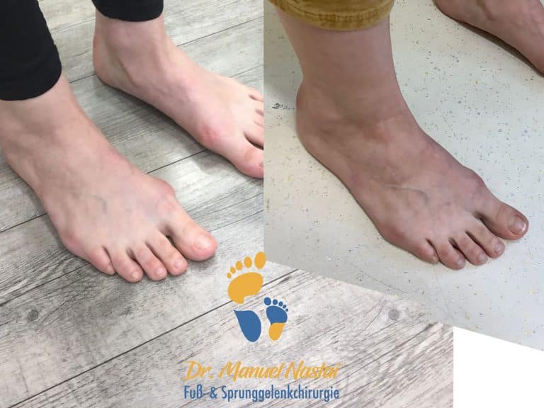 Ergebnis nach minimalinvasiver Hallux valgus Operation