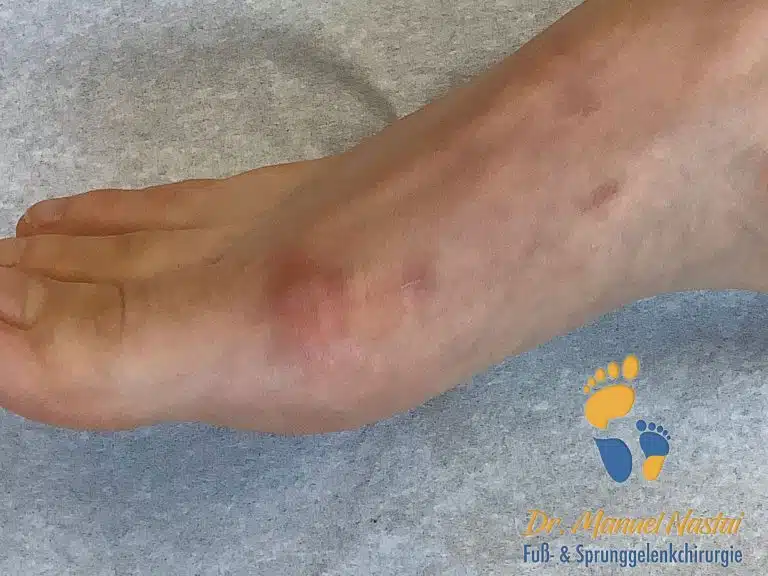 Aussehen der Narben nach minimalinvasiver Hallux valgus Op