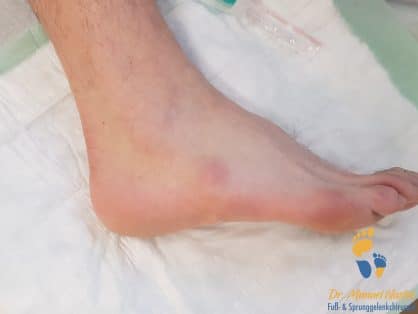 Überbein (Ganglion) am Fuß - Erkennen, Entfernen, Vorbeugen