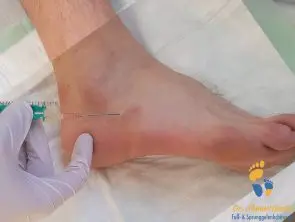 Abpunktiertes Überbein (Ganglion) am Fuß