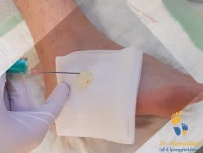Inhalt eines Überbeins (Ganglion) am Fuß nach Punktion