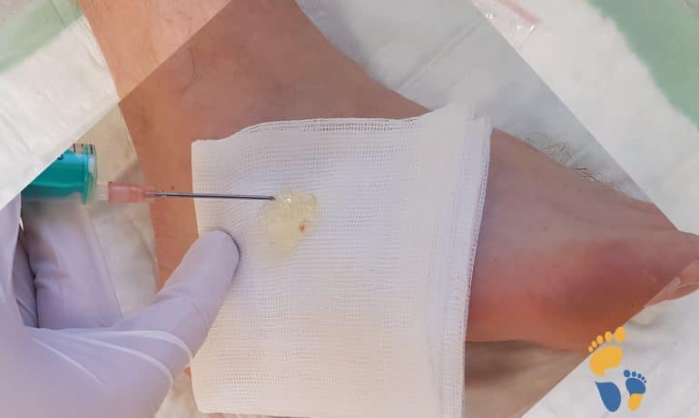 Inhalt eines Überbeins (Ganglion) am Fuß nach Punktion