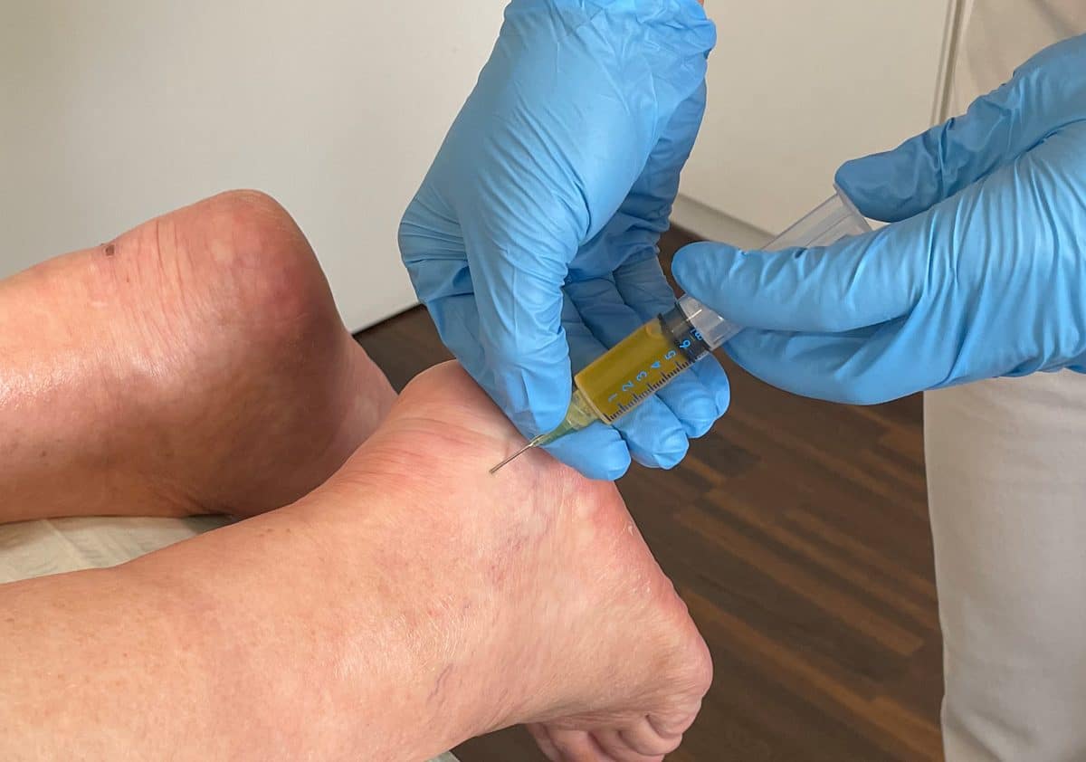 Eigenbluttherapie am Fuß (PRP, Plättchen-reiches Plasma)