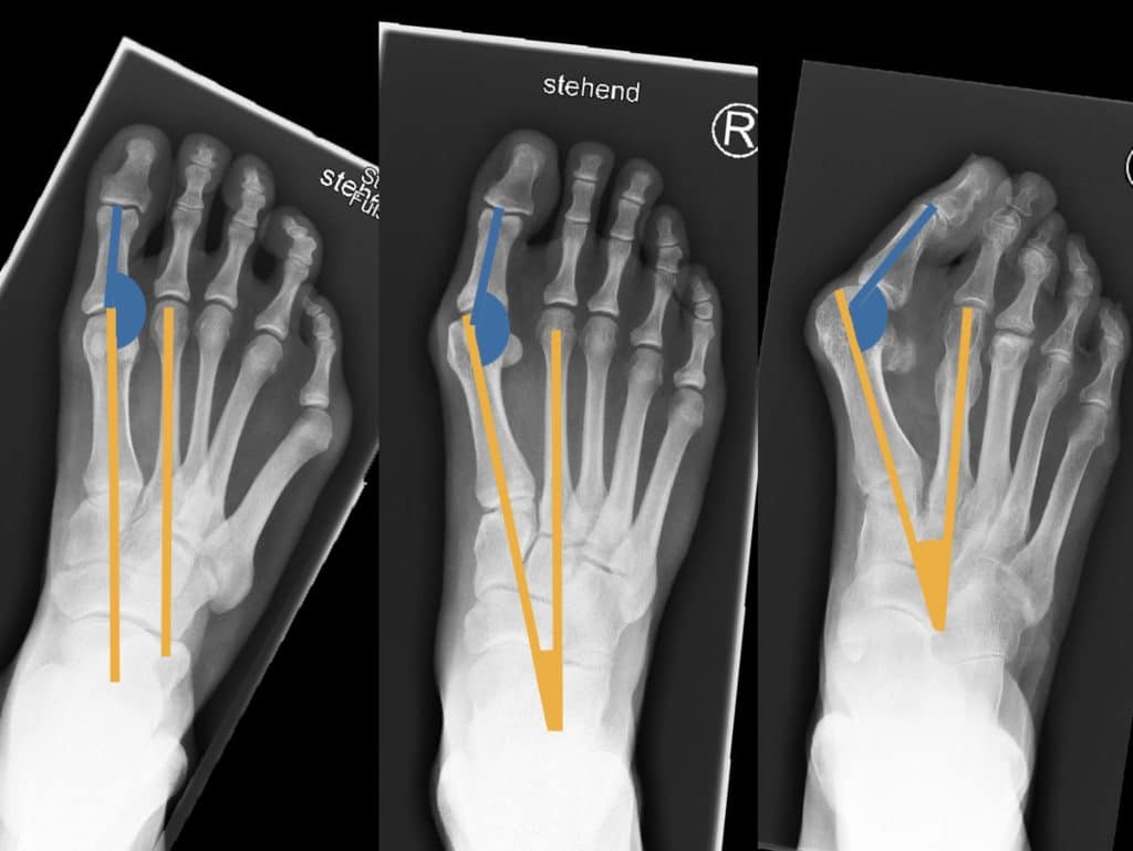 Winkelmessung bei Hallux valgus