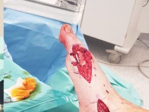 Z-Plastik bei Hallux varus