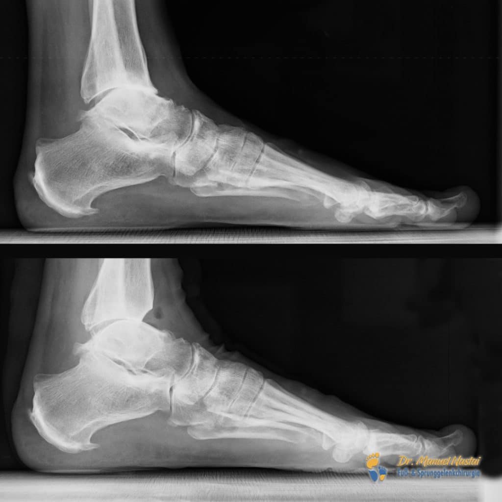 Ergebnis nach minimalinvasiver Exophytenabtragung am Sprunggelenk