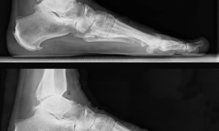 Ergebnis nach minimalinvasiver Exophytenabtragung am Sprunggelenk