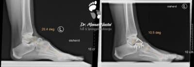 Hohlfußkorrektur durch chopart`sche Arthrodese