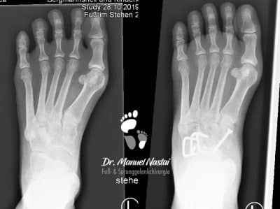 Hohlfußkorrektur durch chopart`sche Arthrodese