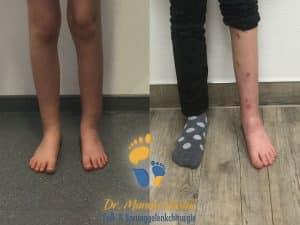 Ergebnis nach unterschenkelkorrektur mit TSF