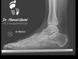 Röntgen-Aufnahme bei Naviculo-cuneiforme Arthrose
