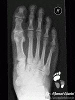 Röntgen-Aufnahme bei Naviculo-cuneiforme Arthrose