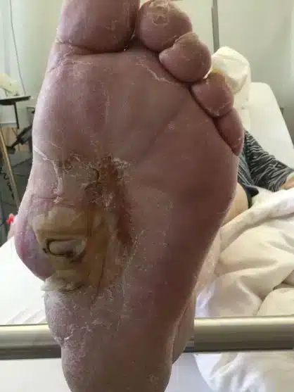 Malum perforans bei Charcot-Fuß