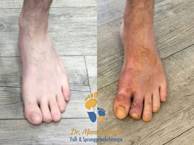 Ergebnis nach Mallet toe-Korrektur