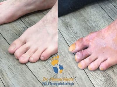Ergebnis nach Mallet toe-Korrektur