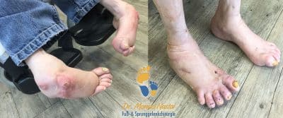 Ergebnis nach Klumpfuß-Korrektur