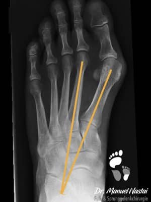 Gering gradiges Hallux valgus