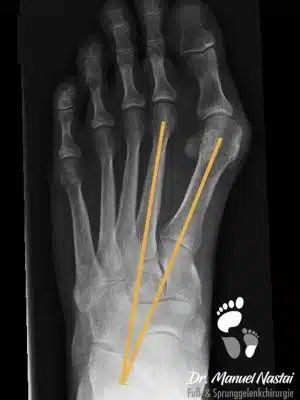 Gering gradiges Hallux valgus Gering gradiges Hallux valgus