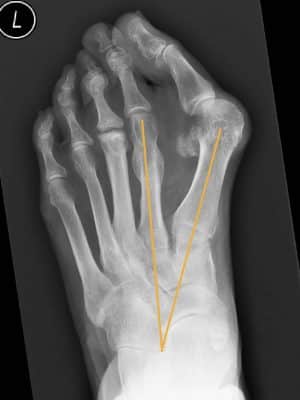 Ausgeprägter Hallux valgus