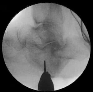 Minimalinvasive Exostosenresektion bei Charcotfuß
