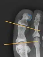 Röntgen-Aufnahme bei Hallux valgus interphalangeus